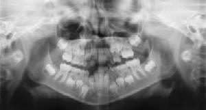 Dental Radiographs (X-Rays) - Pediatric Dentist in Springfield, MO
