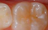 Sealant-Before - Pediatric Dentist in Springfield, MO